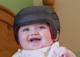 Baby girl wearing a cranial remolding helmet for flat head