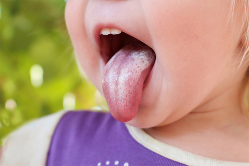 close up of a child showing their whitened tongue